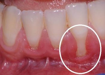 Colletti dentali scoperti: cosa fare?