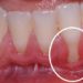 Colletti dentali scoperti: cosa fare?