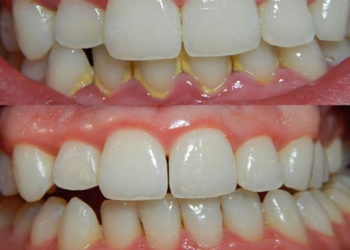 Tartaro: come eliminarlo evitando il dentista