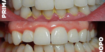 Tartaro: come eliminarlo evitando il dentista